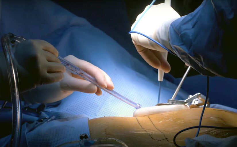 Benefits of Laparoscopic Surgery for Children: Less Pain and Faster Recovery